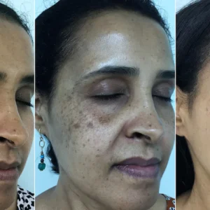 Dark spot/Stretch mark removal spell