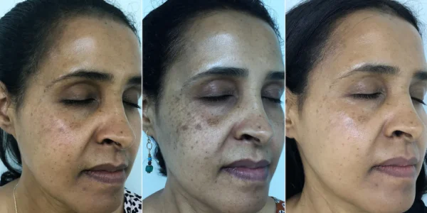 Dark spot/Stretch mark removal spell